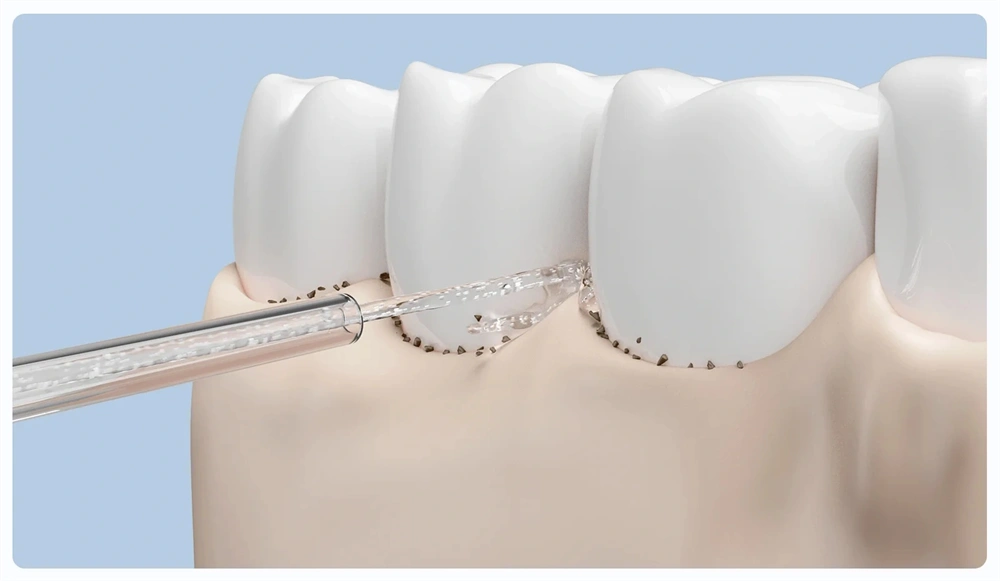 Xiaomi BHR9938GL Water Flosser Replacement Tips szájzuhany pótfej